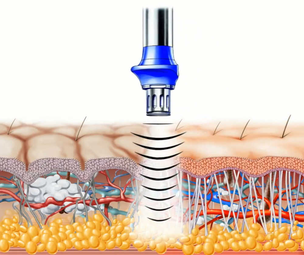 Терапия действием. Ударно-волновая терапия при целлюлите. Ультразвуковая волновая терапия. Контактный ультразвук. Разрушение ультразвуком.